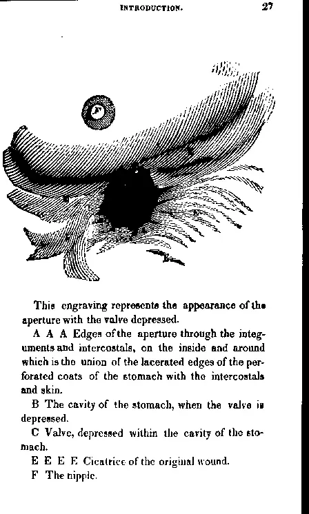 Engraving by William Beaumont showing Alexis St Martin's gastric fistula, 1822